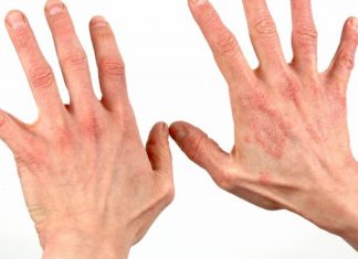 Pemfigusul vulgar – o maladie dermatologica periculoasa