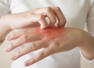 Urticaria, o boala rebela