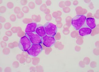 Leucemie limfatica cronica, tratamente noi