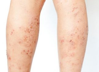 Vasculita cutanata: tratament naturist