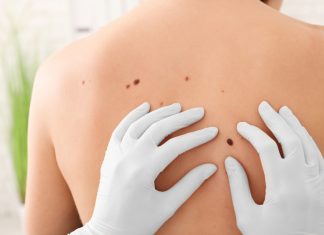 Cancerul de piele: tipuri, cauze, simptome